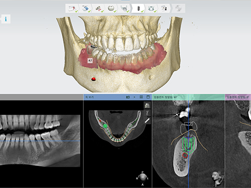 3D 디지털 모의수술